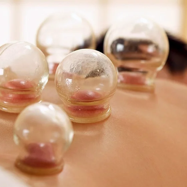 cupping-therapy-alternative-medicine_edited